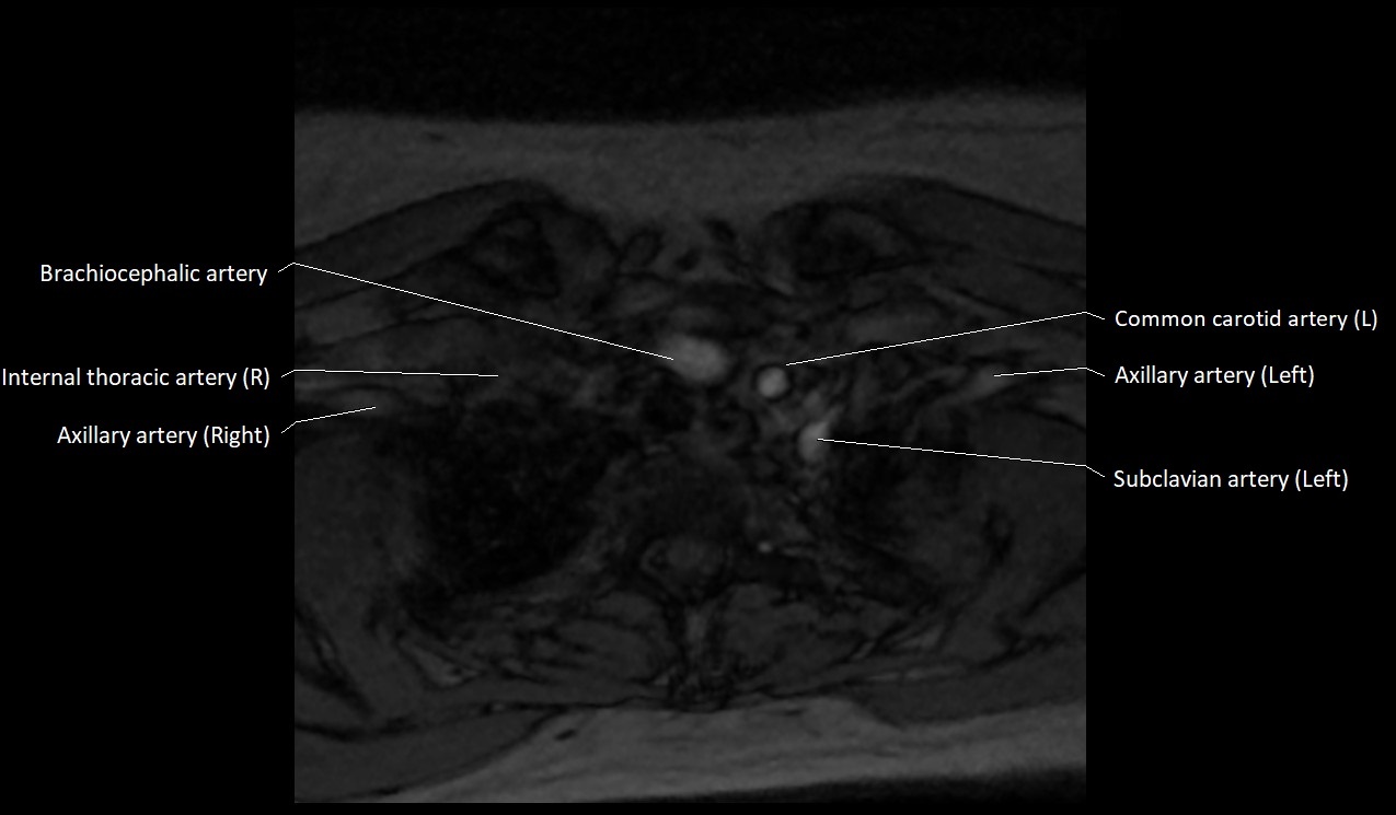 Carotid artery anatomy axial 3T image 73.jpg